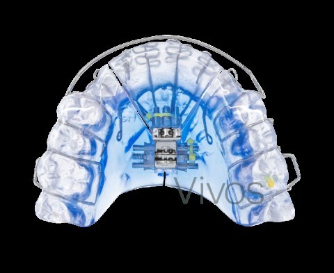 Vivos DNA dental appliance