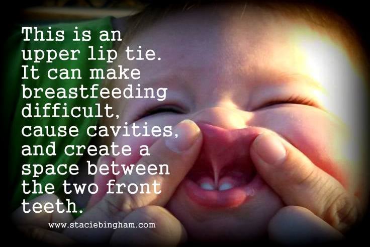 Upper lip-tie in infant